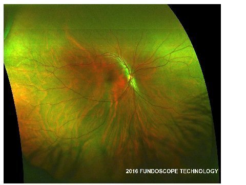 Janesicl commercial fundoscope human eye image
